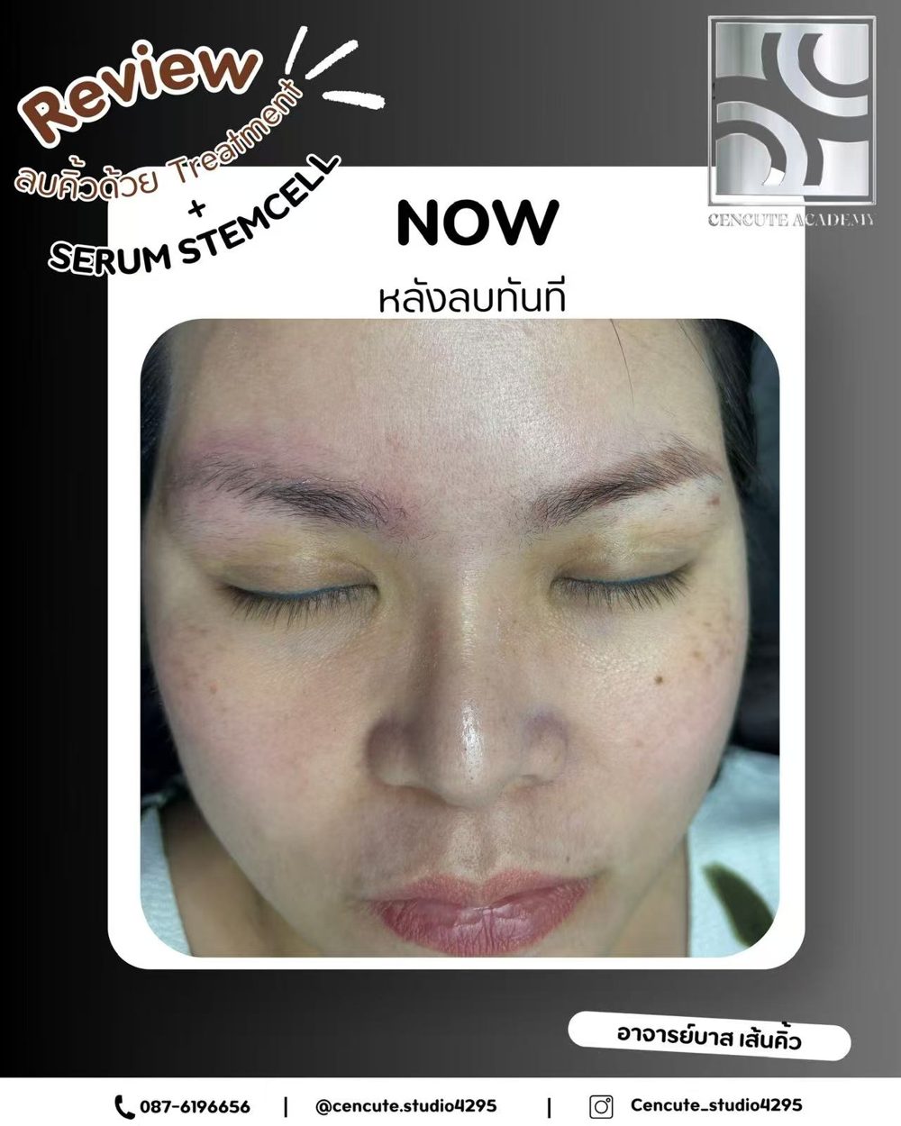 Scarless brow removal (treatment + stem-cell serum) · Cencute Studio