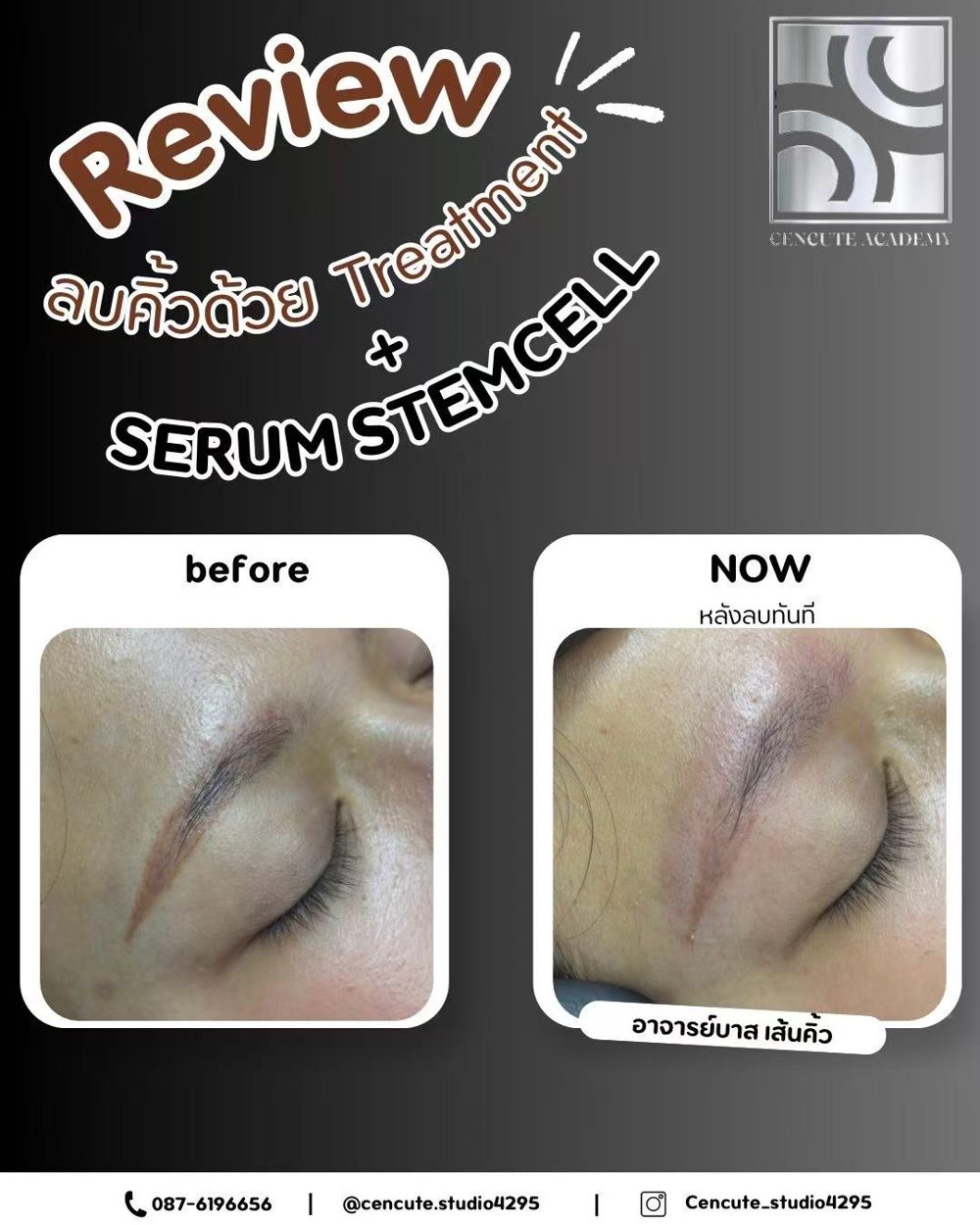 Scarless brow removal (treatment + stem-cell serum) · Cencute Studio