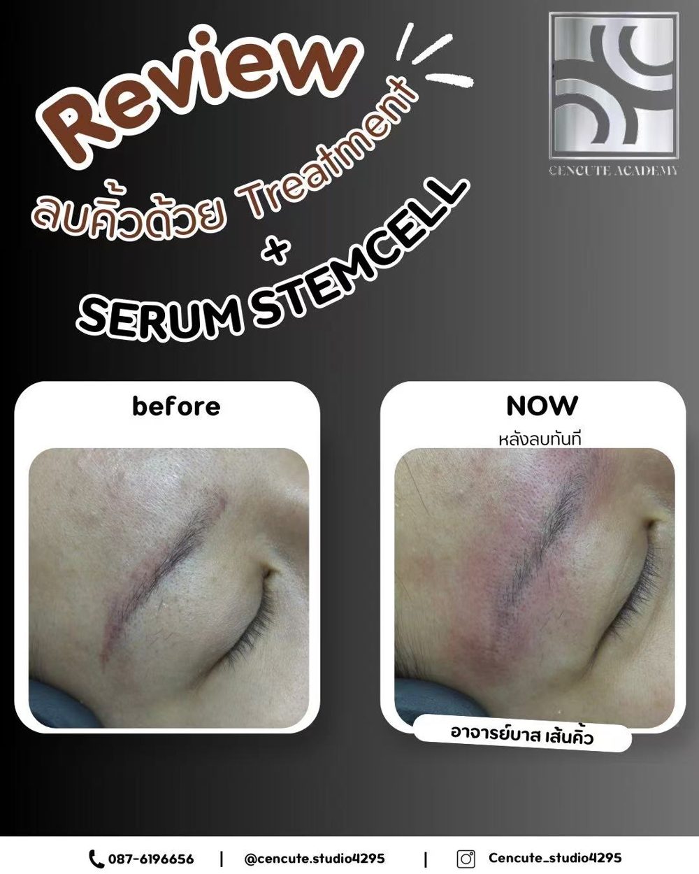 Scarless brow removal (treatment + stem-cell serum) · Cencute Studio